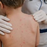 Statistica alarmanta aproape jumatate dintre copii nu sunt vaccinati impotriva rujeolei