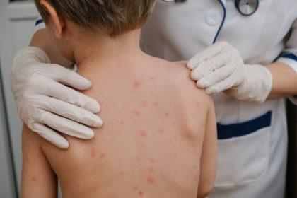 Statistica alarmanta aproape jumatate dintre copii nu sunt vaccinati impotriva rujeolei