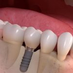 Cat timp dureaza un implant dentar si cum poti sa i prelungesti viata