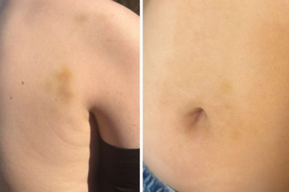 cazul copilului agresat de tatal unui coleg in parc la sibiu are fractura nazala iar mama a solicitat ordin de protectie